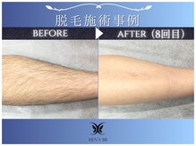 メンズビービー 福井高柳店(MEN'S BB)/ボディ脱毛施術事例