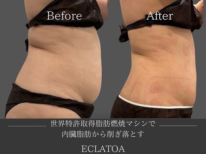 【次世代脂肪冷却・小顔ハイリフト専門店】ECLATOA　四日市/痩身/ダイエットの写真