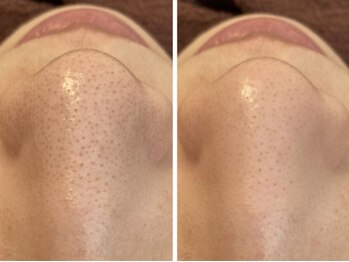 サロンドエルサ(Salon de ELSA)の写真/毛穴の角栓・黒ずみ・開きを解決！粒子の細かい国産ハーブピーリングでつるすべ肌へ◎