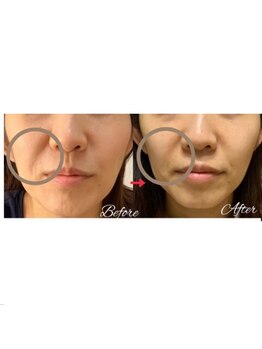 ピリナ 名古屋/【フォトRF美顔/エイジング】