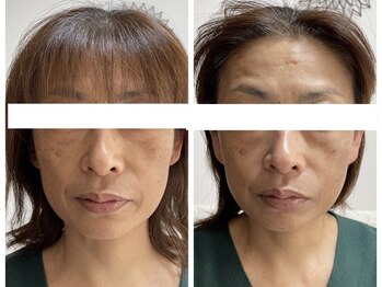 サクラ(SAKURA)/美鍼AIRコース【小顔/たるみ】