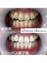 ホワイトニングサロン 京都烏丸店/ホワイトニング施術例