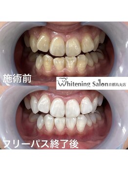 ホワイトニングサロン 京都烏丸店/ホワイトニング施術例