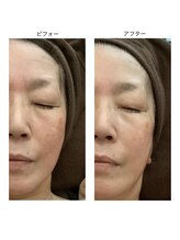 アクア エステティコ 亀有(ACQUA estetico)/小顔エイジングケア目元美容液　