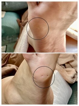 ドクターネイル爪革命 麻布十番店/【魚の目ケア】フットケア