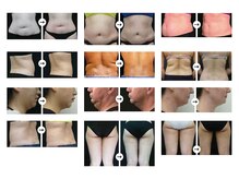 ミロク(369)/脂肪冷却痩身