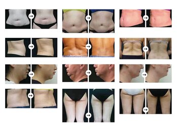 ミロク(369)/脂肪冷却痩身