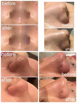 トリアングル(TLIENGLE)/美肌に毛穴はいりませんハイドラ