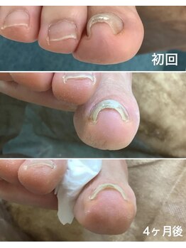 リゼラアンドコー 布施店/巻き爪ケアこちらも途中経過