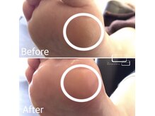 ネイルサロン アニーアンドジーノ(NAIL SALON Annie&Gino)/夏に向けて角質ケア