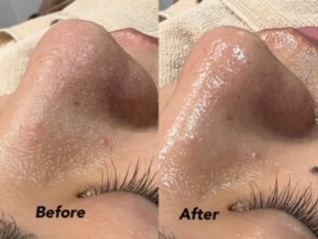 クイーン(QUEEN)/毛穴ケア