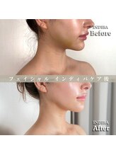 術後の女神 大阪心斎橋店/術後ケアインディバ・インディバ