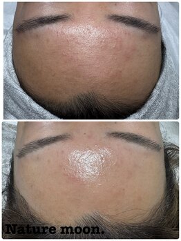 ナチュールムーン(Nature moon.)/毛穴・ハーブピーリング