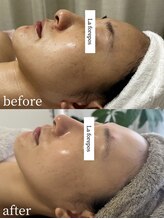 ラ フォルポ 恵比寿(La forepos)/veruna無農薬ハーブピーリング