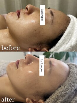 ラ フォルポ 恵比寿(La forepos)/veruna無農薬ハーブピーリング