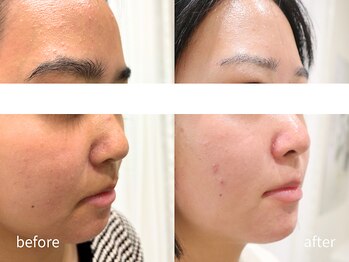 マイ フェア レディ(MY FAIR LADY)/肌質改善