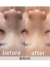 ネムレル森(Nemureru森)/毛穴洗浄【水巻/八幡西区/折尾】