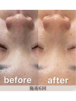 ネムレル森(Nemureru森)/毛穴洗浄【水巻/八幡西区/折尾】