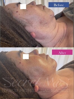 メンズエフディ ファウンデーション(メンズFD)/最強小顔