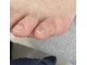 【フット】副爪ケア