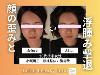 ルルラボ(LuLu beauty labo)/顔の歪みと浮腫みを撃退！