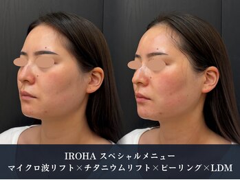 イロハ(IROHA)の写真/次世代最強小顔施術*マイクロ波リフト導入サロン◆二重顎/たるみ/もたつきに!脂肪減少・効果を即実感