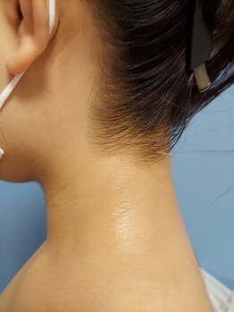 キアラ 麻布十番(Kiara)/うなじ脱毛