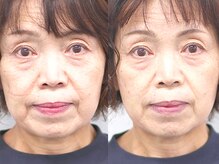 初回施術は、お顔全体の美容鍼を行い、施術前と後の効果を実感