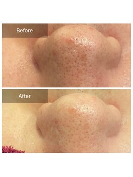 リジュベ(Rejuve)/毛穴エクストラクション[本八幡]