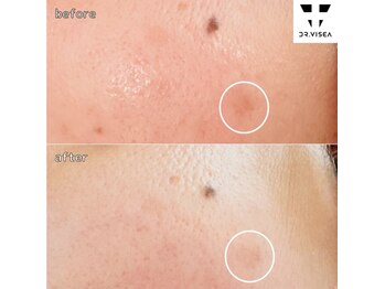 ルミラポー(Lumira Peau)/20代1回