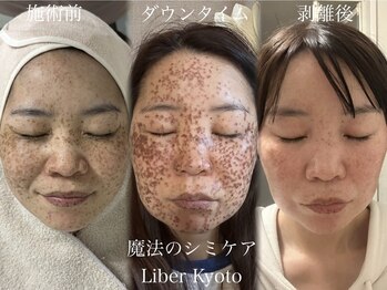 エステティック リベル キョウト 京都駅前店(Esthetic Liber Kyoto)/魔法のシミケア