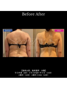 ドルチェビューティーサロン 戸塚安行店(Dolce Beauty Salon)/痩身（上半身）_施術20回