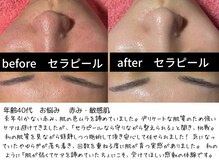 パルテール/赤み・敏感肌が悩み【口コミ】