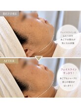 ブリリアントスマイル/たるみをとるにはレモンボトル