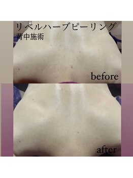 ココ(COCO)/背中ニキビケアもお任せ♪