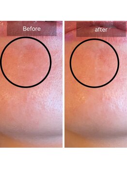 ラ ドウ 名古屋黒川店(la.dow)/毛穴汚れの原因角栓