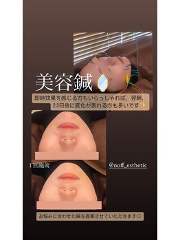 ノフ 恵比寿(noff)/美容鍼効果