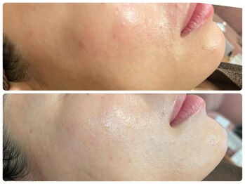 ブリリアント(Brilliant)/ハーブピーリング効果