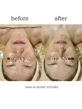 サロン ド ブラン アオヤマ(Salon de BLANC AOYAMA)/BLANC式小顔/水艶肌ソノケア