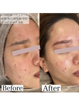 ロミエール(LOMIERE)/ハーブピーリング