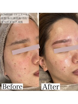 ロミエール(LOMIERE)/ハーブピーリング