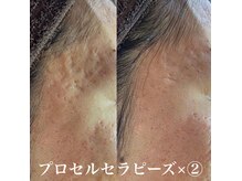 長年のお悩みを解消つるんとした理想の肌へ/プロセルセラピーズ