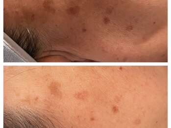 サロン ラズリ 久留米店(SALON Lazuli)/【イオン導入】シミ/美白