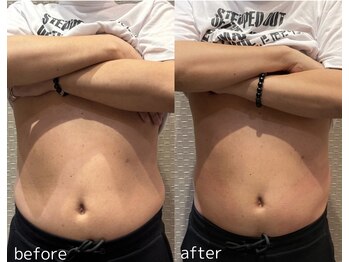 ビュウナ 銀座(BEAUNA)/メンズ【脂肪冷却&たるみ改善】