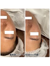 ハーシークレット(Her secret)/ハーブピーリング効果・くすみ