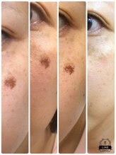 メイプルリーフ/シミケア