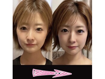 ネルジム 札幌店(NERU GYM)/ダウンタイムも必要ありません☆