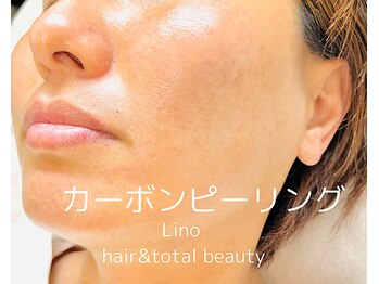 リノ(Lino)/カーボンピーリング