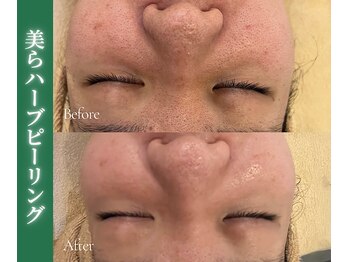 アイランドハーブ 沖縄おもろまち店/ハーフピーリング