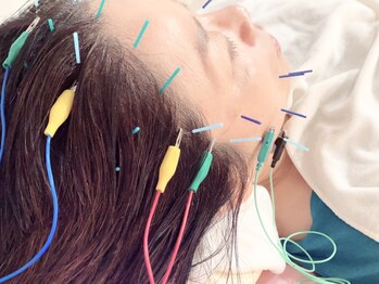 瑞 鍼灸院/頭皮鍼+美容鍼